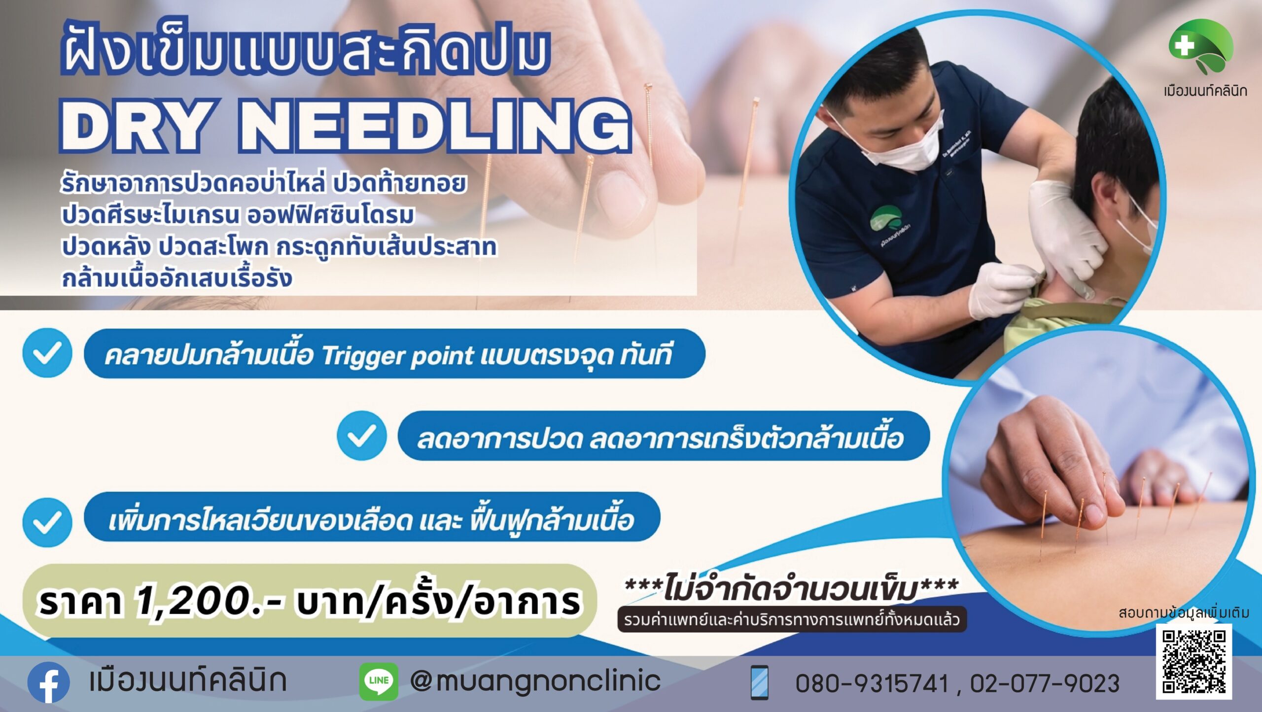 ฝังเข็มแบบสะกิดปม Dry Needling  รักษาอาการปวดคอบ่าไหล่