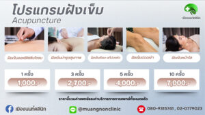 โปรแกรมฝังเข็ม Acupuncture